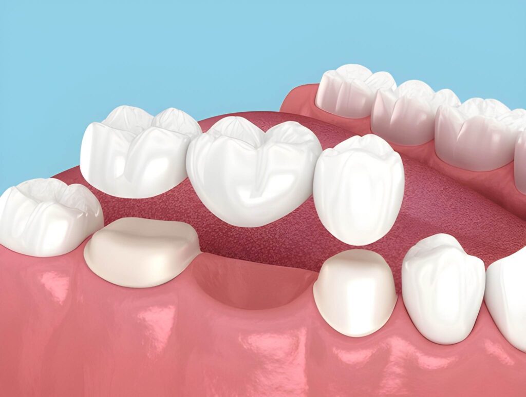 dental crowns & bridges near you