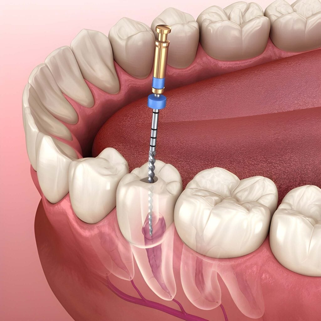 Root canal treatment illustration showing dental tools cleaning infected tooth pulp in Woodland Hills, California.
