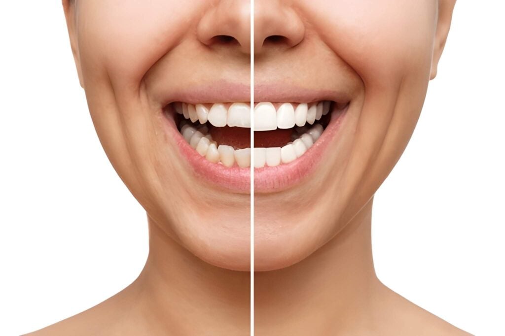 Before and after smile transformation with professional teeth whitening.