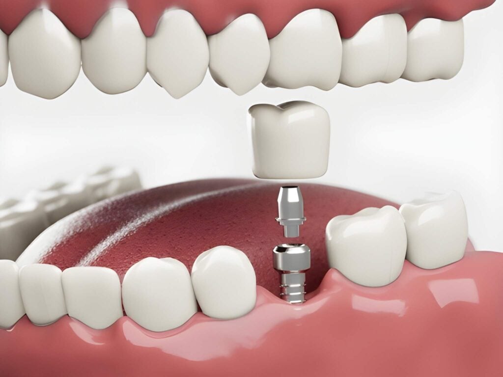 Dental implant procedure illustration showing titanium implant and custom crown restoration.