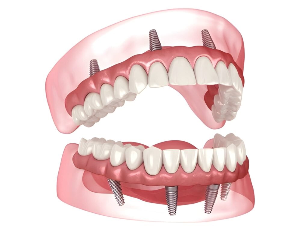 Full mouth dental implants (All-On-X) with a complete arch of teeth attached to implant posts.