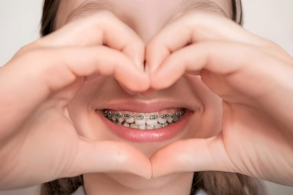 Smiling face with braces forming a heart shape, orthodontic treatment for a confident smile in