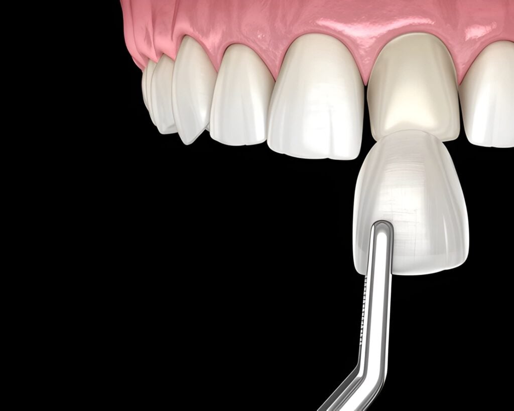Porcelain veneer application on tooth demonstrating cosmetic dental procedure in Woodland Hills, California.