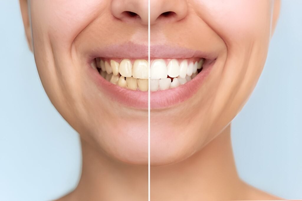 Before and after teeth whitening showcasing brighter, whiter smile.