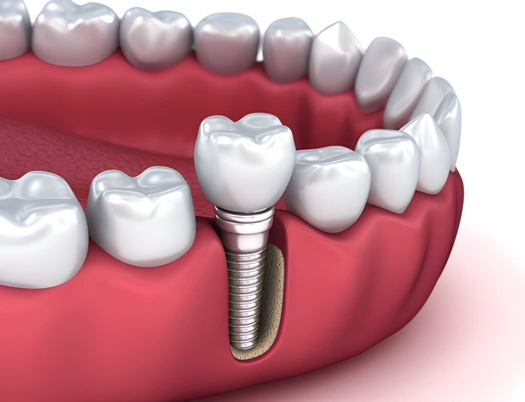 TeethXpress same-day dental implant illustration showing implant post and new teeth restoration.