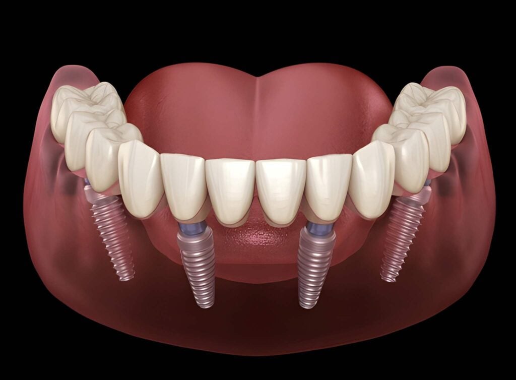 TeethXpress same-day dental implants illustration showing implant posts and temporary teeth restoration.