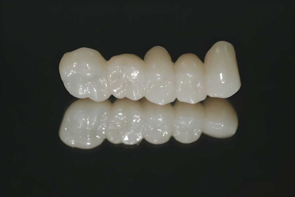 Zirconia fixed bridge showcasing natural-looking tooth replacement in Woodland Hills, California.