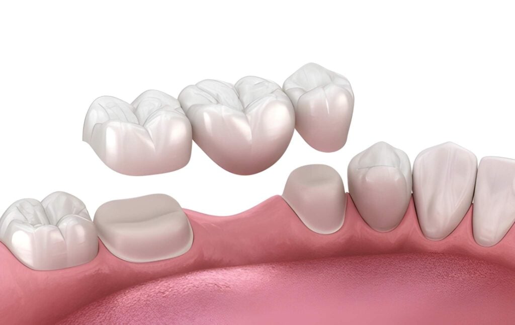 Zirconia fixed bridge replacing missing teeth in a dental arch, showcasing a natural tooth appearance.